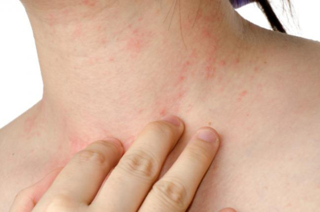 terapia natural para mejorar piel seca e irritada